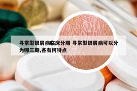 寻常型银屑病临床分期 寻常型银屑病可以分为哪三期,各有何特点