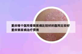 重庆哪个医院看银屑病比较好的医院比较好 重庆银屑病治疗费用