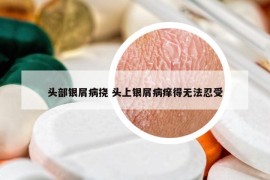 头部银屑病挠 头上银屑病痒得无法忍受