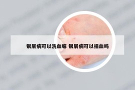 银屑病可以洗血嘛 银屑病可以捐血吗