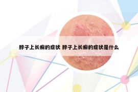 脖子上长癣的症状 脖子上长癣的症状是什么