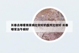 长春去哪看银屑病比较好的医院比较好 长春哪家治牛癣好