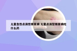 儿童急性点滴性银屑病 儿童点滴型银屑病吃什么药