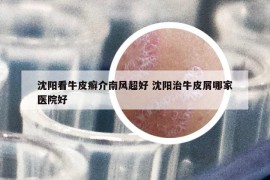 沈阳看牛皮癣介南风超好 沈阳治牛皮屑哪家医院好