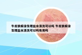 牛皮肤癣涂生理盐水清洗可以吗 牛皮肤癣涂生理盐水清洗可以吗有用吗