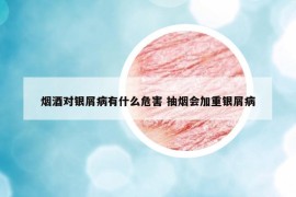 烟酒对银屑病有什么危害 抽烟会加重银屑病