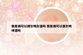 银屑病可以偶尔喝白酒吗 银屑病可以偶尔喝啤酒吗