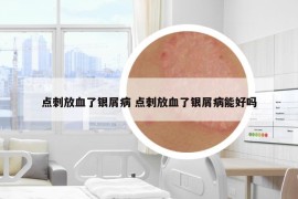 点刺放血了银屑病 点刺放血了银屑病能好吗