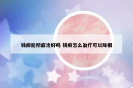 钱癣能彻底治好吗 钱癣怎么治疗可以除根