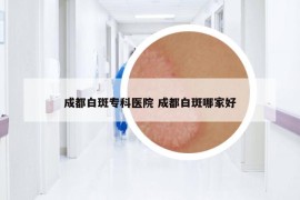 成都白斑专科医院 成都白斑哪家好