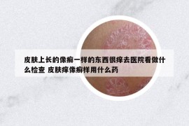 皮肤上长的像癣一样的东西很痒去医院看做什么检查 皮肤痒像癣样用什么药