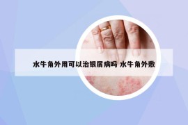 水牛角外用可以治银屑病吗 水牛角外敷