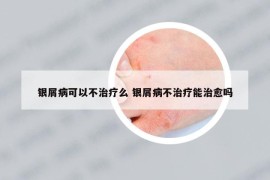 银屑病可以不治疗么 银屑病不治疗能治愈吗