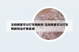 沈阳哪里可以打生物制剂 沈阳哪里可以打生物制剂治疗银屑病