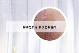 癣该怎么治 癣该怎么治疗