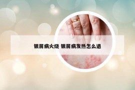 银屑病火烧 银屑病发热怎么退