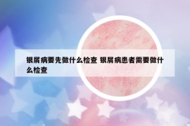 银屑病要先做什么检查 银屑病患者需要做什么检查