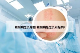 银削病怎么除根 银削病是怎么引起的?