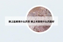 脚上起癣用什么药膏 脚上长藓擦什么药最好