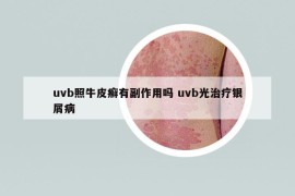 uvb照牛皮癣有副作用吗 uvb光治疗银屑病