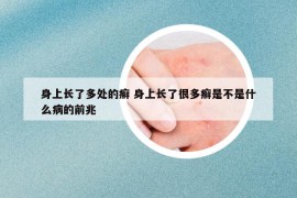 身上长了多处的癣 身上长了很多癣是不是什么病的前兆