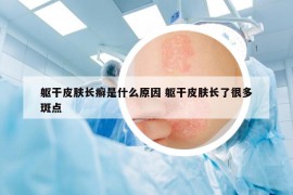 躯干皮肤长癣是什么原因 躯干皮肤长了很多斑点