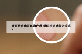 掌跖脓疱病可以治疗吗 掌跖脓疱病能治愈吗?