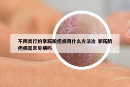 不同类行的掌跖脓疱病用什么方法冶 掌跖脓疱病是常见病吗