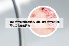 银屑病什么时候能进入社保 银屑病什么时候可以出攻克的药物