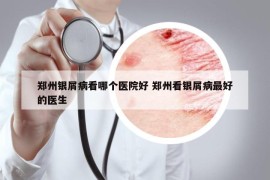 郑州银屑病看哪个医院好 郑州看银屑病最好的医生