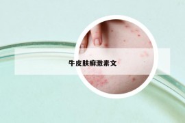 牛皮肤癣激素文