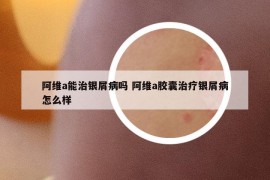 阿维a能治银屑病吗 阿维a胶囊治疗银屑病怎么样