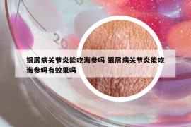 银屑病关节炎能吃海参吗 银屑病关节炎能吃海参吗有效果吗