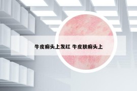 牛皮癣头上发红 牛皮肤癣头上