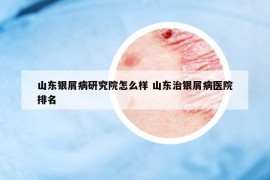 山东银屑病研究院怎么样 山东治银屑病医院排名