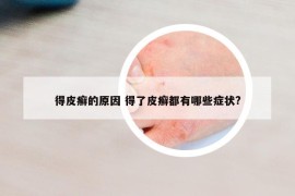 得皮癣的原因 得了皮癣都有哪些症状?