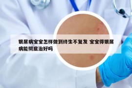 银屑病宝宝怎样做到终生不复发 宝宝得银屑病能彻底治好吗