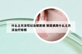 什么土方法可以治银屑病 银屑病用什么土方法治疗除根