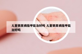 儿童银屑病指甲能治好吗 儿童银屑病指甲能治好吗