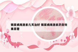 银屑病用激素几天治好 银屑病用激素药膏效果显著