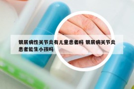 银屑病性关节炎有儿童患者吗 银屑病关节炎患者能生小孩吗