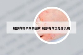 腿部白斑早期的图片 腿部有白斑是什么病