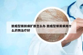 脓疱型银削病扩散怎么办 脓疱型银屑病用什么药物治疗好