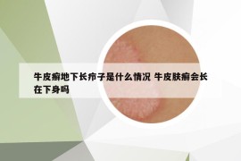 牛皮癣地下长疖子是什么情况 牛皮肤癣会长在下身吗