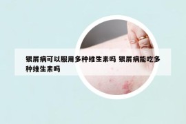 银屑病可以服用多种维生素吗 银屑病能吃多种维生素吗