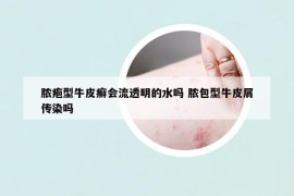 脓疱型牛皮癣会流透明的水吗 脓包型牛皮屑传染吗