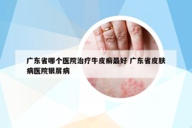 广东省哪个医院治疗牛皮癣最好 广东省皮肤病医院银屑病