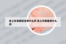 身上长有癣应该用什么药 身上长癣是用什么药