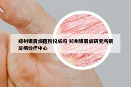 郑州银屑病医院权威吗 郑州银屑病研究所银屑病诊疗中心