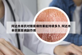 阿达木单抗对银屑病效果能持续多久 阿达木单抗银屑病副作用